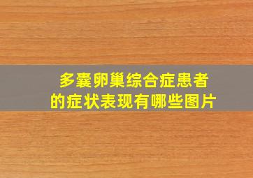 多囊卵巢综合症患者的症状表现有哪些图片